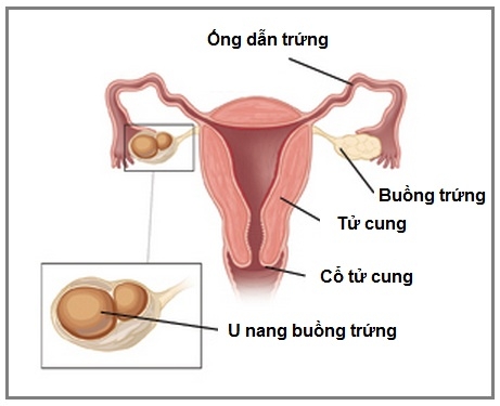 Bệnh u nang buồng trứng