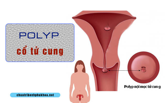 Polyp cổ tử cung là bệnh