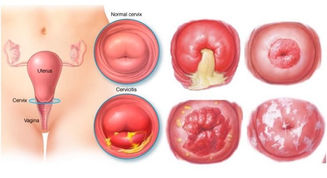 Bệnh viêm lộ tuyến cổ tử cung