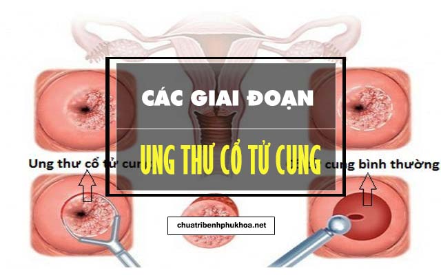 Thuốc điều trị bệnh ung thư cổ tử cung