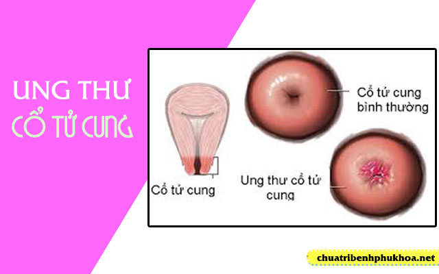 bệnh ung thư cổ tử cung