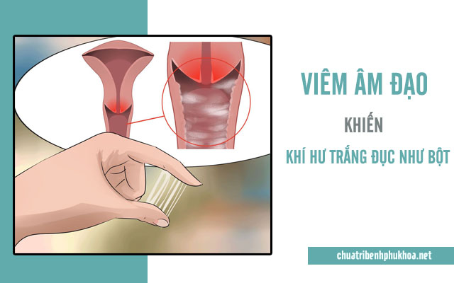  khí hư trắng đục như bột do viêm âm đạo