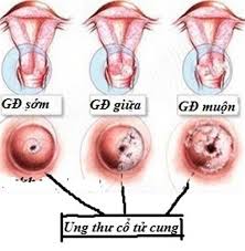 Cách chữa bệnh ung thư cổ tử cung theo từng giai đoạn