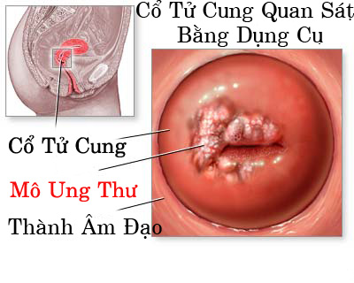 Những biểu hiện của ung thư cổ tử cung cần biết