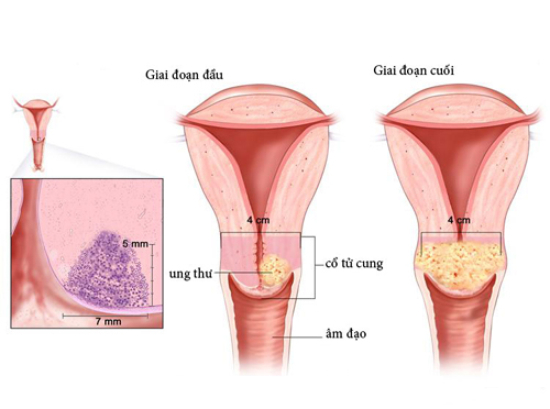 Những triệu chứng của bệnh ung thư cổ tử cung