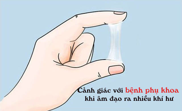 Ra nhiều khí hư là triệu chứng viêm phụ khoa 