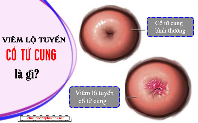 Bệnh viêm lộ tuyến cổ tử cung là gì