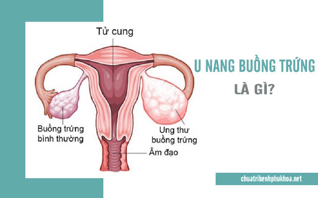 U nang buồng trứng là bệnh gì?