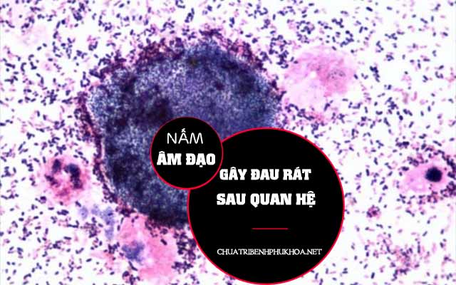 bị đau rát và ngứa sau khi quan hệ do nhiễm nấm