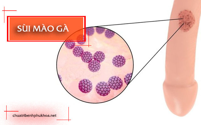 các bệnh phụ khoa nam giới