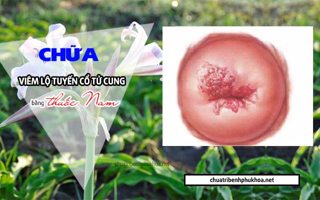 chữa viêm lộ tuyến cổ tử cung bằng thuốc nam