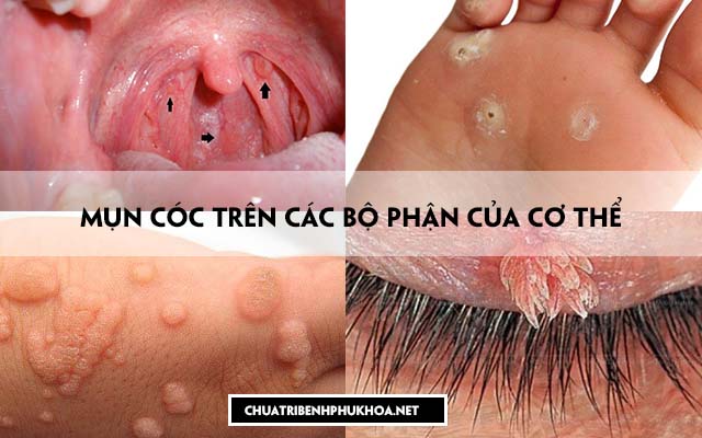 dấu hiệu bệnh sùi mào gà ở nữ