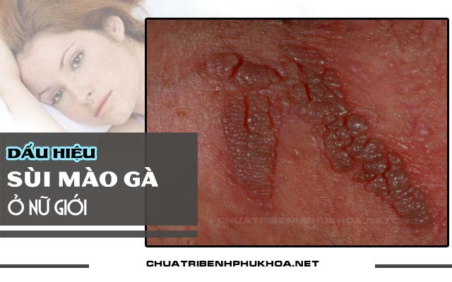 triệu chứng sùi mào gà ở nữ