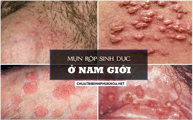 mụn rộp sinh dục ở nam giới