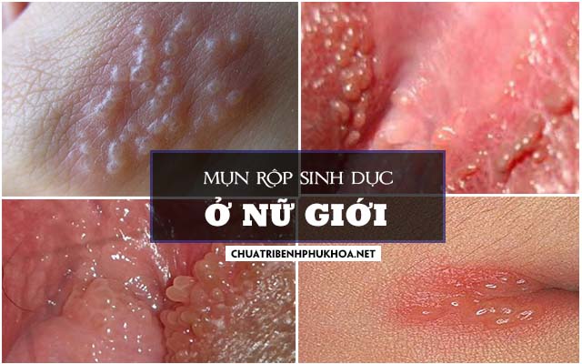 cách chữa mụn rộp sinh dục nữ