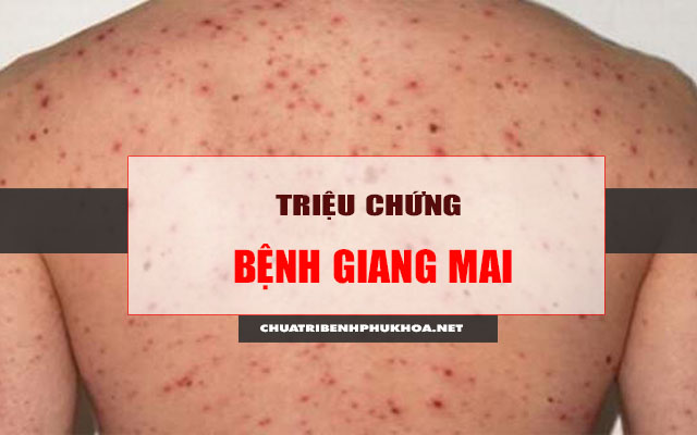  dấu hiệu của bệnh giang mai