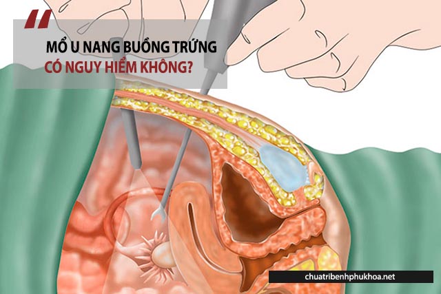 mổ u nang buồng trứng có nguy hiểm không