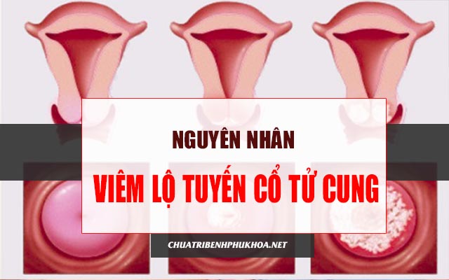 nguyên nhân gây viêm lộ tuyến cổ tử cung