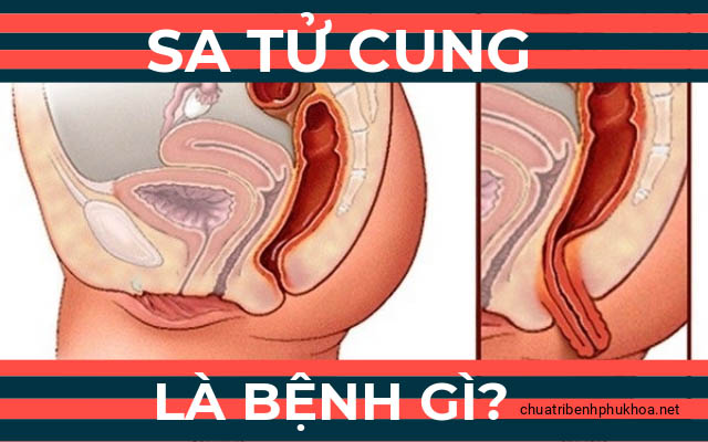 sa tử cung là bệnh gì