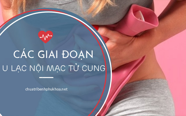 các giai đoạn của u lạc nội mạc tử cung