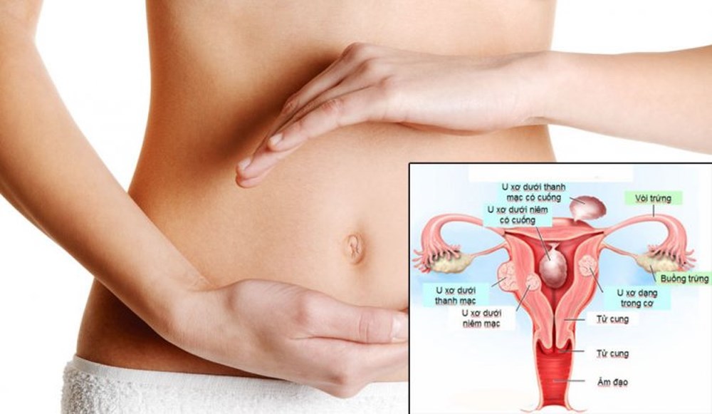 Bệnh nhân xơ tử cung là gì