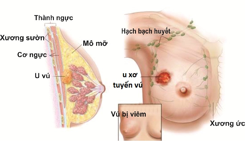 Bệnh u xơ tuyến vú