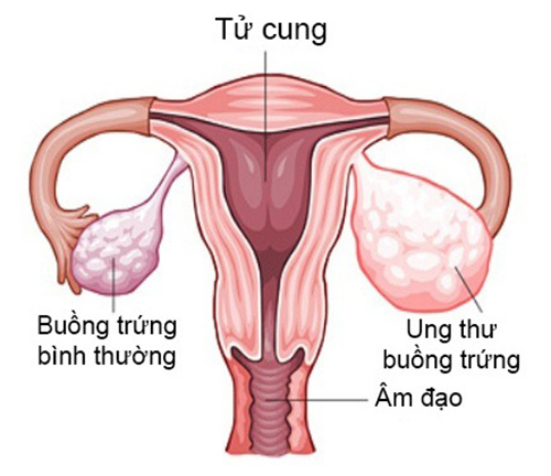 Không nên coi thường: Khí hư màu nâu có thể do ung thư buồng trứng