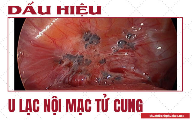 dấu hiệu u lạc nội mạc tử cung