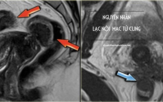 nguyên nhân u lạc nội mạc tử cung