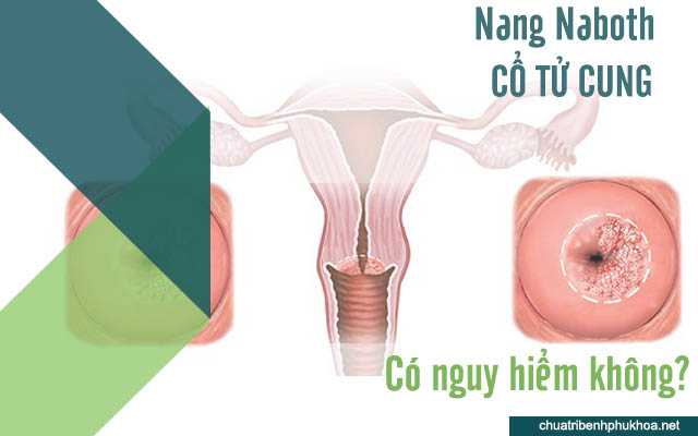 Nang naboth cổ tử cung có nguy hiểm không