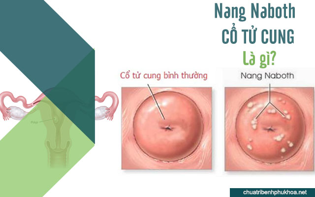 Nang naboth cổ tủ cung là gì?