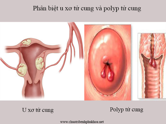 Phân biệt u xơ tử cung và polyp tử cung