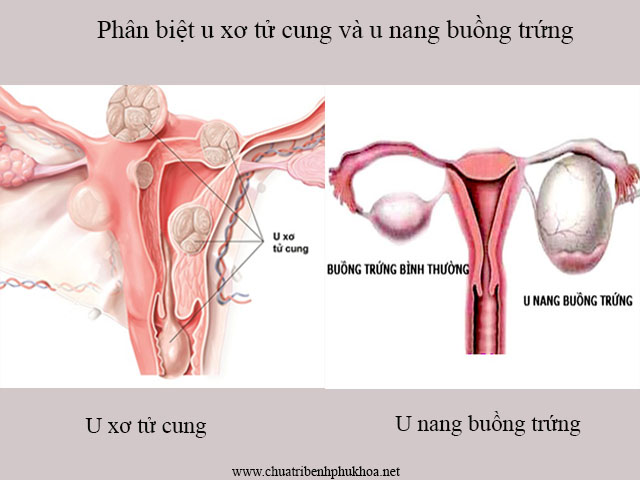 Phân biệt u xơ tử cung và u nang buồng trứng