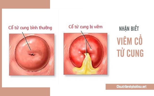 Bệnh viêm cổ tử cung