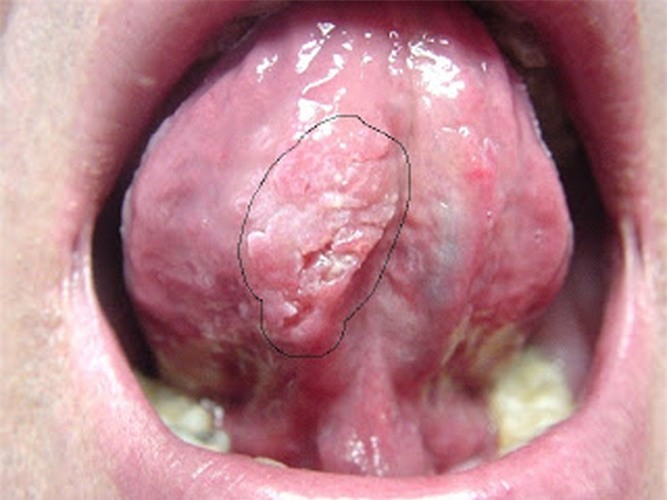 Triệu chứng bệnh sùi mào gà ở lưỡi