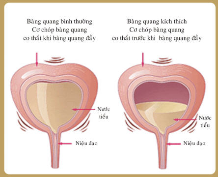 6-trieu-chung-viem-bang-quang1