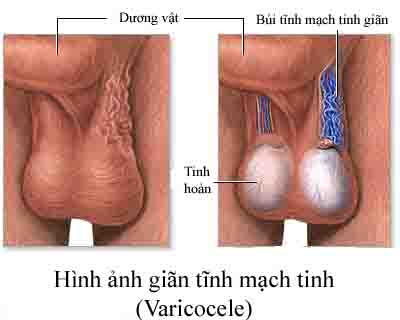 nguyen-nhan-gian-tinh-mach-thung-tinh-va-cach-dieu-tri