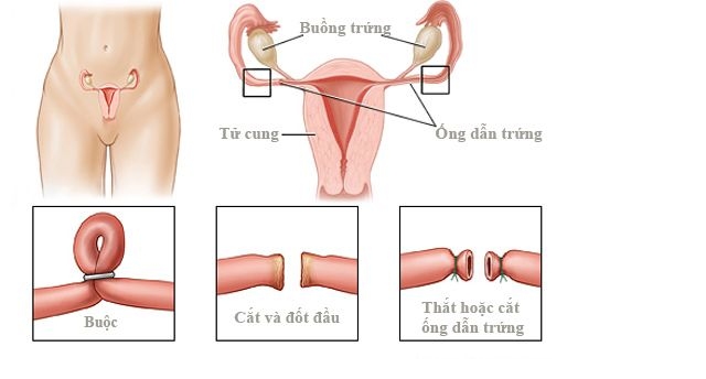 Quy trình thắt ống dẫn chứng