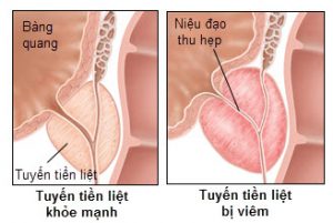 di-tieu-nhieu-lan-trong-ngay-la-benh-gi2