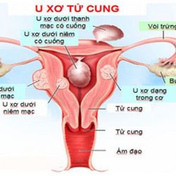 U xơ tử cung