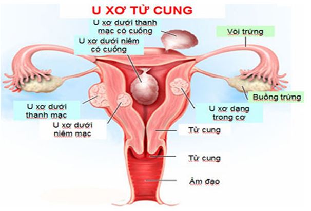 U xơ tử cung