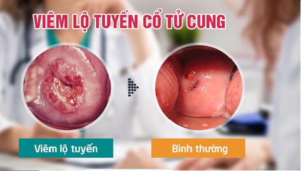 viêm lộ tuyến cổ tử cung