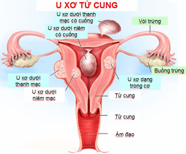 Thuốc phụ khoa gia truyền dòng họ Nguyễn điều trị hiệu quả u xơ tử cung