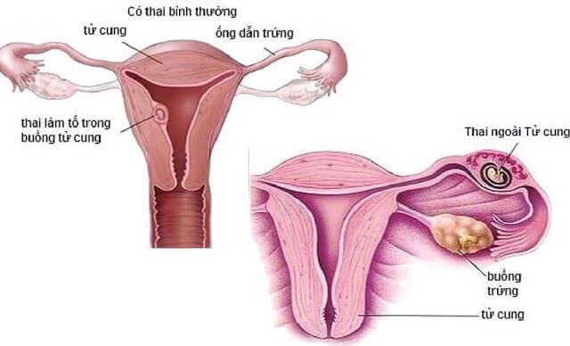 Mang thai ngoài tử cung là một biến chứng của bệnh viêm vùng chậu