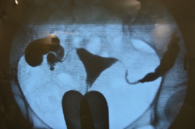 Hình ảnh chụp X-quang chẩn đoán bệnh u xơ cổ tử cung