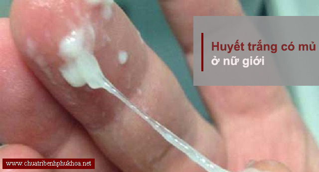  Huyết trắng có mủ là gì?