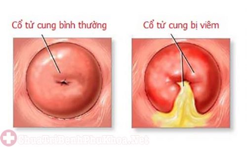 Viêm cổ tử cung