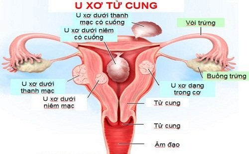 Hình ảnh u xơ cổ tử cung dưới niêm mạc tử cung