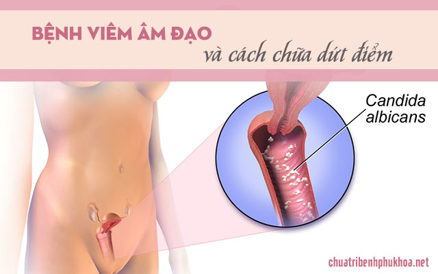 Phụ nữ dễ mắc bệnh viêm âm đạo