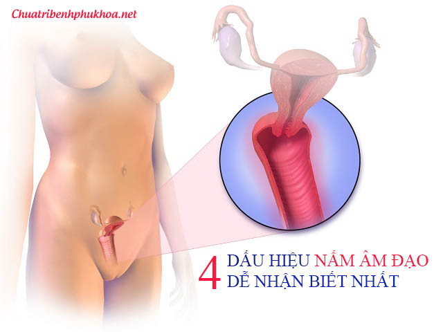 dấu hiệu nấm âm đạo